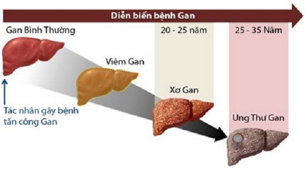Các triệu chứng báo hiệu xơ gan do rượu